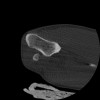 SPORK, NICO - 22.03.1976 - 02.08.2022 - CT obere Extremität - 17:51:17